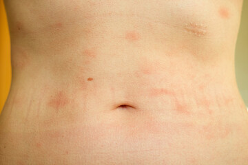 Fototapeta premium Atopic dermatitis on the abdominal skin of a woman, severe itching on the side. Allergy or urticaria, hives