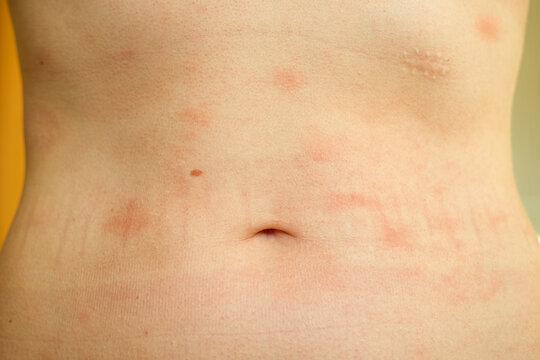 Atopic dermatitis on the abdominal skin of a woman, severe itching on the side. Allergy or urticaria, hives