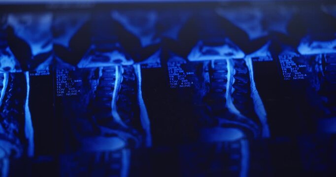 Mri scan of spinal column with disc protrusion in detailed view.