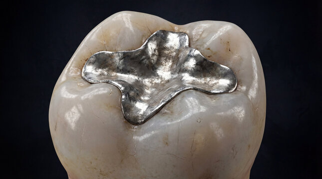 tooth with silver filling, dental care, oral health, dentistry concept