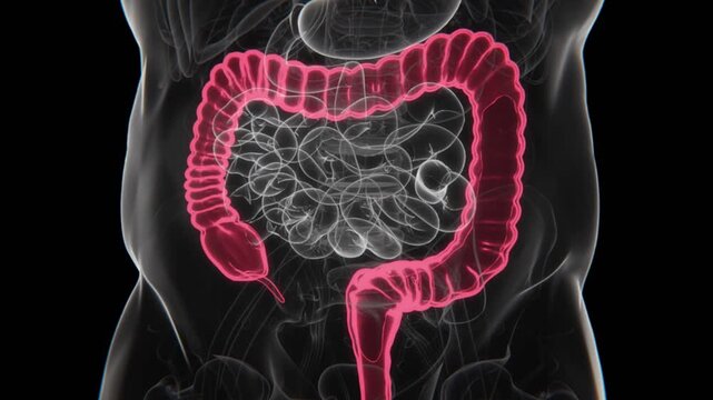 Ulcerative Colitis Indication X-ray in HD Video | Ulcerative Colitis X-ray in HD Video