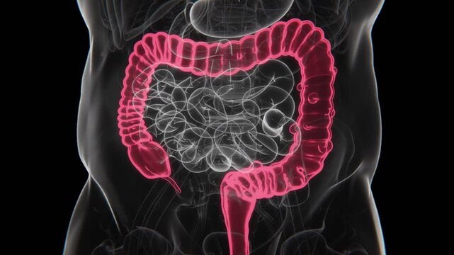 Diverticulitis Indication X-ray in HD Video | Diverticulitis X-ray in HD Video