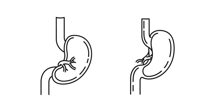 Gastric Bypass Surgery Diagram: Before and After Comparison of Stomach Anatomy