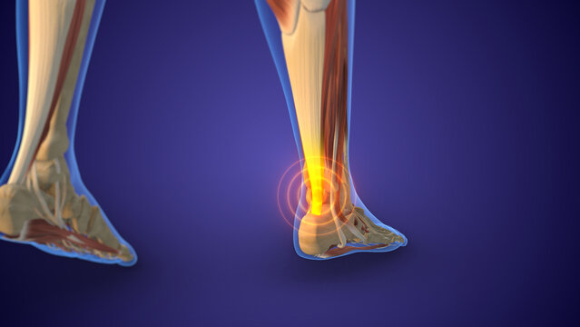 Achilles Tendon Injury with Pain Highlight in Human Ankle