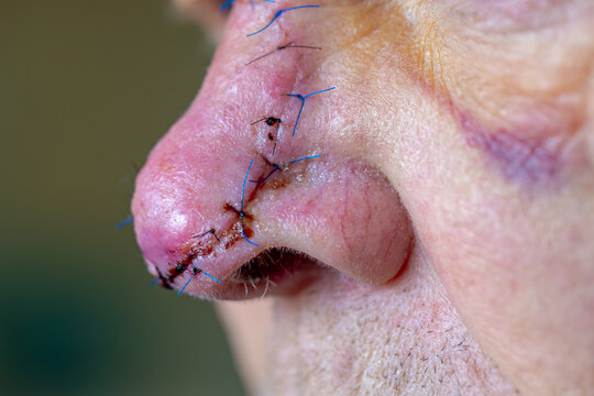 Health care concept, Selective focus of a man nose with surgical wound, Stitches and blood after operation, Basal-cell carcinoma (BCC) also known as basal-cell cancer is the common type of skin cancer