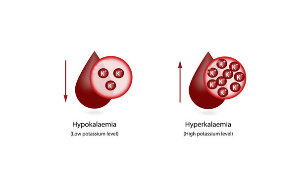 	
Hyperkalaemia, high plasma potassium level and Hypokalaemia, low plasma potassium level. Potassium K excess and deficit electrolyte disorders, blood test tube, Scientific design. Vector illustration