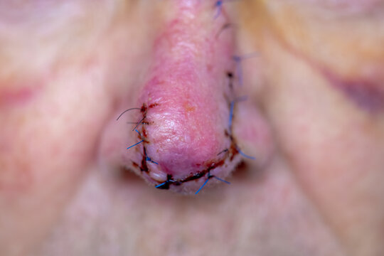 Health care concept, Selective focus of a man nose with surgical wound, Stitches and blood after operation, Basal-cell carcinoma (BCC) also known as basal-cell cancer is the common type of skin cancer