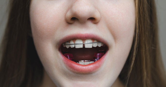 Macro image of a teenage girl's teeth with orthodontic wire and purple plate installed, concept of pediatric dentistry and bite correction process. Twin block
