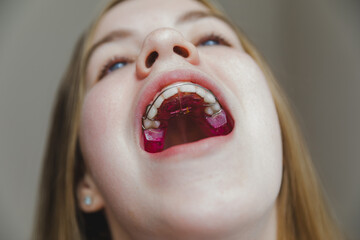 Low angle macro view of pink orthodontic plate installed on teenage girl's upper jaw, professional bite correction and pediatric dental hardware © inna717