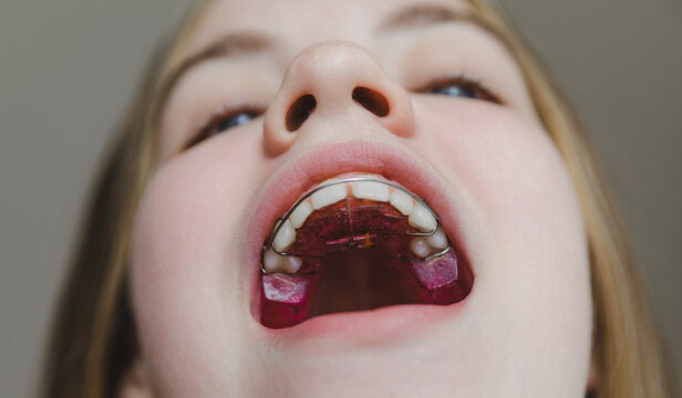 Low angle macro view of pink orthodontic plate installed on teenage girl's upper jaw, professional bite correction and pediatric dental hardware