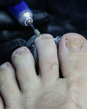 Vertical photo of diseased toenails being filed.