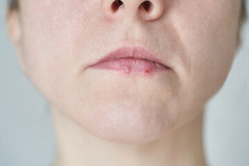 Close-up of adult caucasian females chapped lips highlighting skin texture and imperfections.