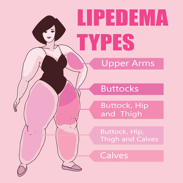 A woman with health problems. Lipedema types. Healthcare illustration. Healthcare infographic. Vector illustration. 