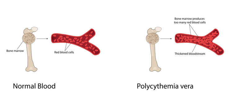 Polycythemia vera vector illustration
