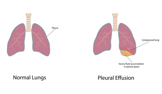 Pleural effusion vector illustration