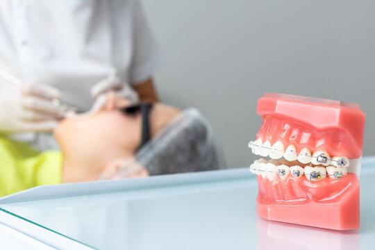 Orthodontic model and dentist tool. Teeth model of varities of orthodontic brackets or braces