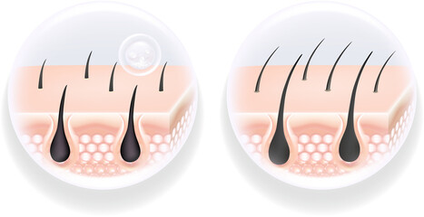 Obraz premium Hyaluronic acid and Niacinamide before and after hair and skin solutions ad. white collagen serum drop into skin cells