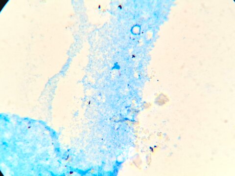 Microscopic view of Mycobacterium tuberculosis in a sputum smear using Ziehl-Neelsen staining. The acid-fast bacilli (AFB) appear as distinct bright red rod-shaped bacteria against a contrasting blue 