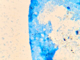 Fototapeta premium Microscopic view of Mycobacterium tuberculosis in a sputum smear using Ziehl-Neelsen staining. The acid-fast bacilli (AFB) appear as distinct bright red rod-shaped bacteria against a contrasting blue 