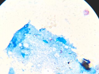 Fototapeta premium Microscopic view of Mycobacterium tuberculosis in a sputum smear using Ziehl-Neelsen staining. The acid-fast bacilli (AFB) appear as distinct bright red rod-shaped bacteria against a contrasting blue 