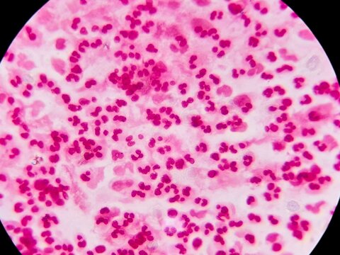 Microscopic view of a Gram-stained smear showing an abundance of polymorphonuclear leukocytes (neutrophils). The cells exhibit characteristic multi-lobed nuclei against a proteinaceous background