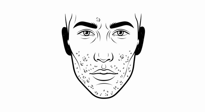 Black and white line drawing of a male face with acne
