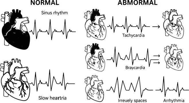 Cardiac rhythms Normal vs. abnormal, showing sinus rhythm, tachycardia, bradycardia, and arrhythmia