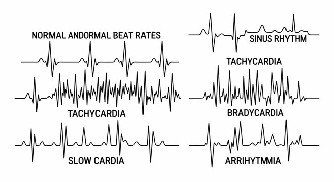 Diverse ECG wave patterns showing normal and abnormal heart rhythms