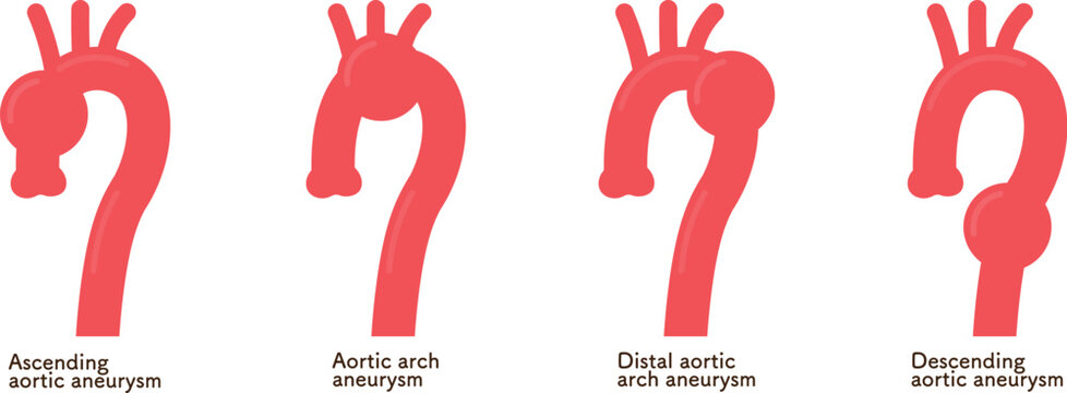 大動脈瘤のイラスト　Illustration of an aortic aneurysm