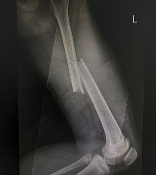 X-ray image of the broken bones of the femur 