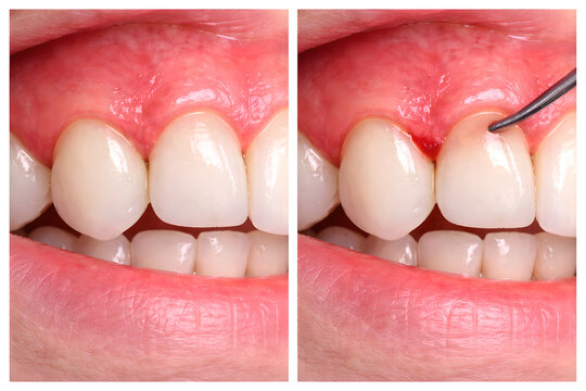 Photorealistic 3D medical referencing the sample: showing oral signs related to micronutrient deficiency Cheilosis, Glossitis (smooth erythematous tongue with reduced papillae), Bleeding, spongy gums