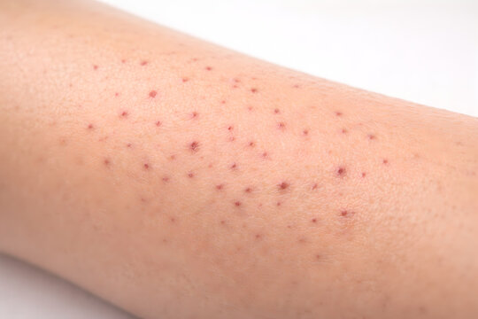 Photorealistic 3D medical infographic showing skin signs associated with micronutrient deficiencies: Xerosis, Follicular hyperkeratosis, Petechiae, Ecchymoses