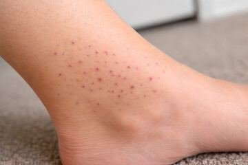 Photorealistic 3D medical infographic showing skin signs associated with micronutrient deficiencies: Xerosis, Follicular hyperkeratosis, Petechiae, Ecchymoses