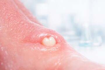 Fototapeta premium Unusual Formation Appears on Skin as White Substance Builds up Over Time