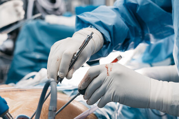Surgical team performing heart valve implantation during open heart surgery, with medical instruments and sterile environment clearly visible in the operating room
