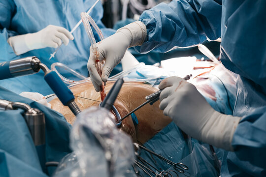Heart surgery procedure close up showing surgical instruments and controlled operating field. Medical precision concept.