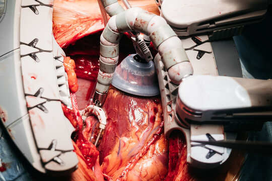 Detailed view of the Octopus cardiac stabilizer positioned on the beating heart during off-pump CABG surgery. Advanced cardiothoracic technology in use.