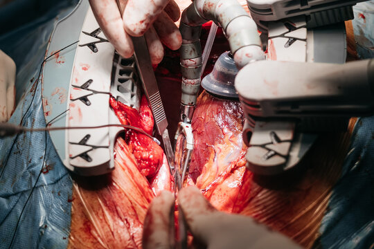 Exposed heart during coronary artery bypass surgery with Octopus stabilizer system attached for myocardial stabilization. Close-up of cardiothoracic surgical field.