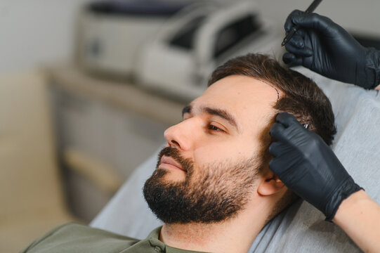 Man undergoing hair transplant procedure marking receding hairline