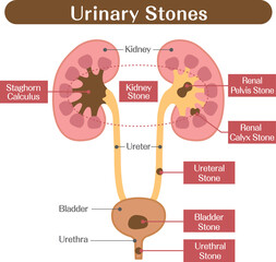 Urinary Stones Diagram Showing Kidney Stone Locations in the Urinary Tract