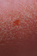 Fototapeta premium Extreme dryness of feet skin texture