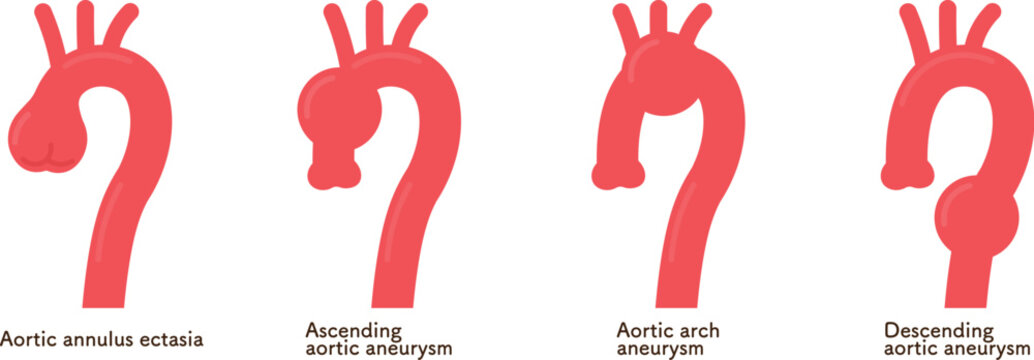 大動脈弁輪拡張症と大動脈瘤 annuloaortic ectasia&aortic aneurysm