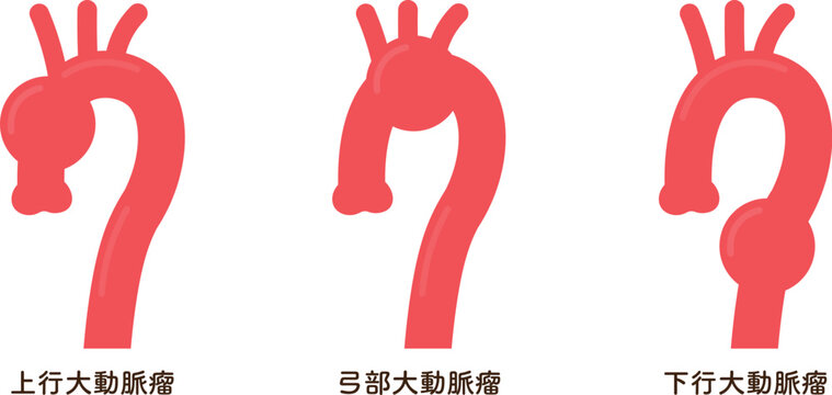 大動脈瘤のイラスト　Illustration of an aortic aneurysm