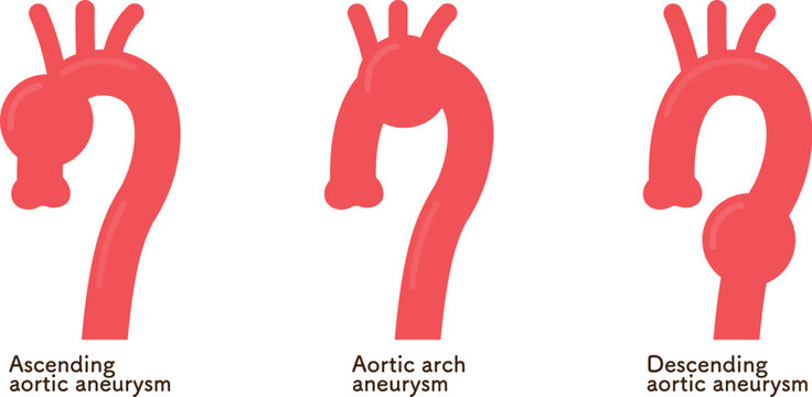 大動脈瘤のイラスト　Illustration of an aortic aneurysm