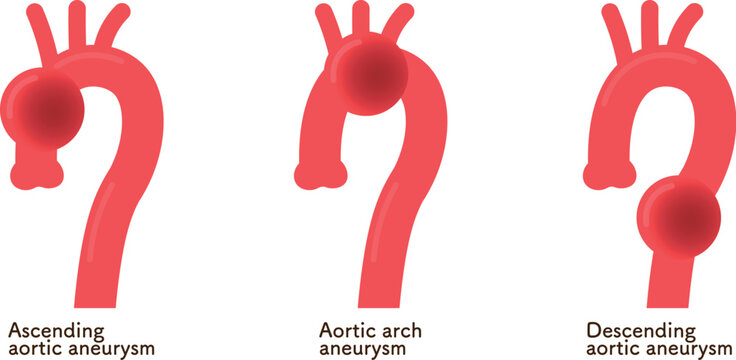 大動脈瘤のイラスト　Illustration of an aortic aneurysm