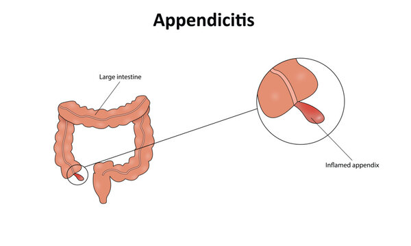 Appendicitis vector illustration