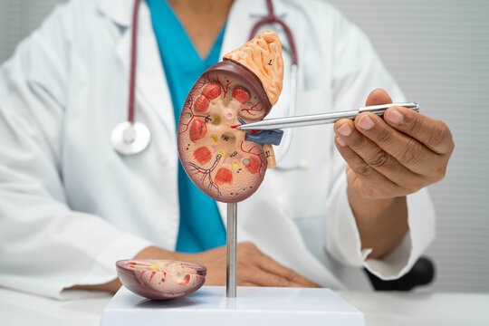 Chronic kidney disease, Asian woman with model for treatment urinary system, urology, Estimated glomerular filtration rate eGFR.