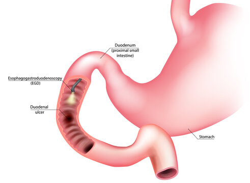 Esophagogastroduodenoscopy EGD Procedure Showing Duodenal Ulcer Medical Illustration. Upper Endoscopy Examination of Duodenum with Peptic Ulcer Diagram