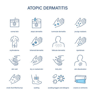Atopic Dermatitis symptoms, diagnostic and treatment vector icon set
