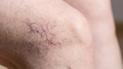 Spider Veins on Human Leg Skin, Varicose Vein and Vascular Health Concept, Dermatology Concern with Visible Capillaries Closeup